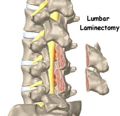 Lumbar laminectomy