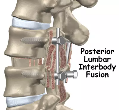 Posterior lumbar interbody fusion