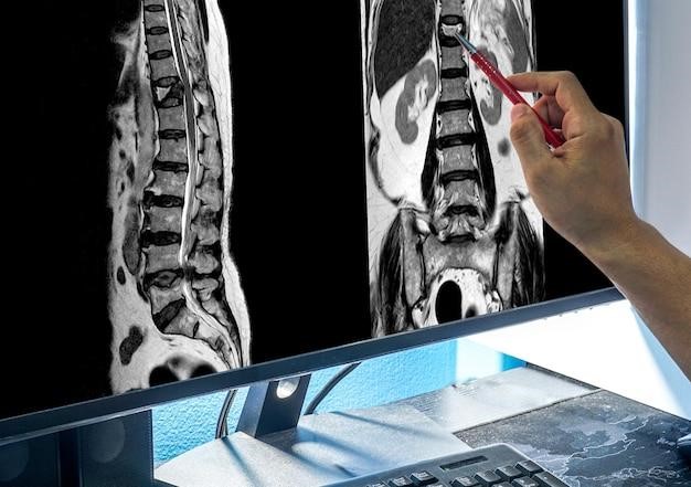 What Is a Lumbar Fusion: An In-depth Look into Spinal Health