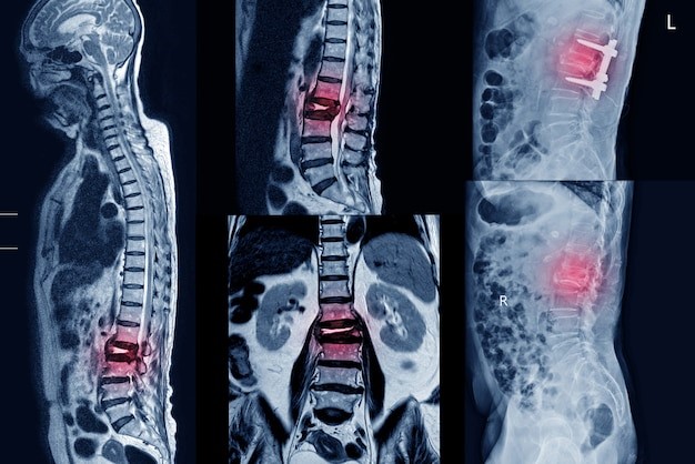 The Comprehensive Guide to Revision Spine Surgery