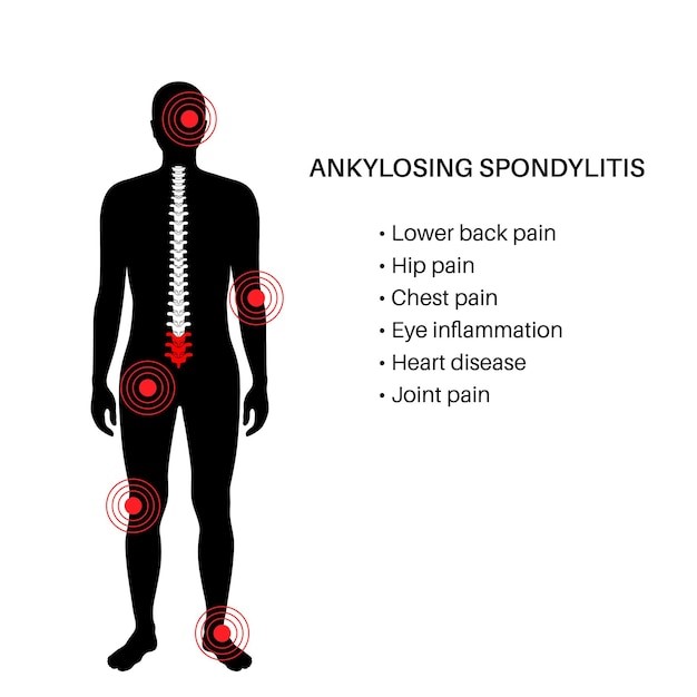 Unlocking a Pain-Free Life: What Lifestyle Changes Help with Ankylosing Spondylitis?