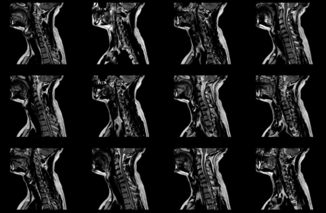 what are effective pain relief options for radiculopathy?