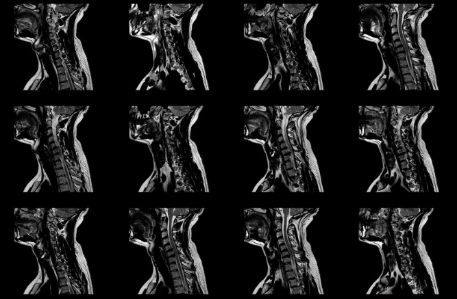 What are Effective Pain Relief Options for Radiculopathy: A Comprehensive Guide